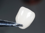 深圳瓷牙貼片修復過程如何？是否靠譜？