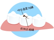 深圳補牙推介，蛀牙一定要補牙？補牙有咩過程？ 