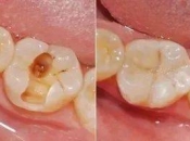 深圳補牙的步驟係點樣嘅？