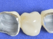 上深圳做嘅烤瓷牙如果壞咗點算？係咪因為烤瓷牙質量唔好？