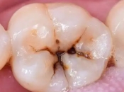 深圳補牙—箍牙是否容易蛀牙？容易蛀牙嘅四大人群！