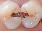 牙齒上有窿會唔會自行治愈？如果去醫院治療需要幾錢？