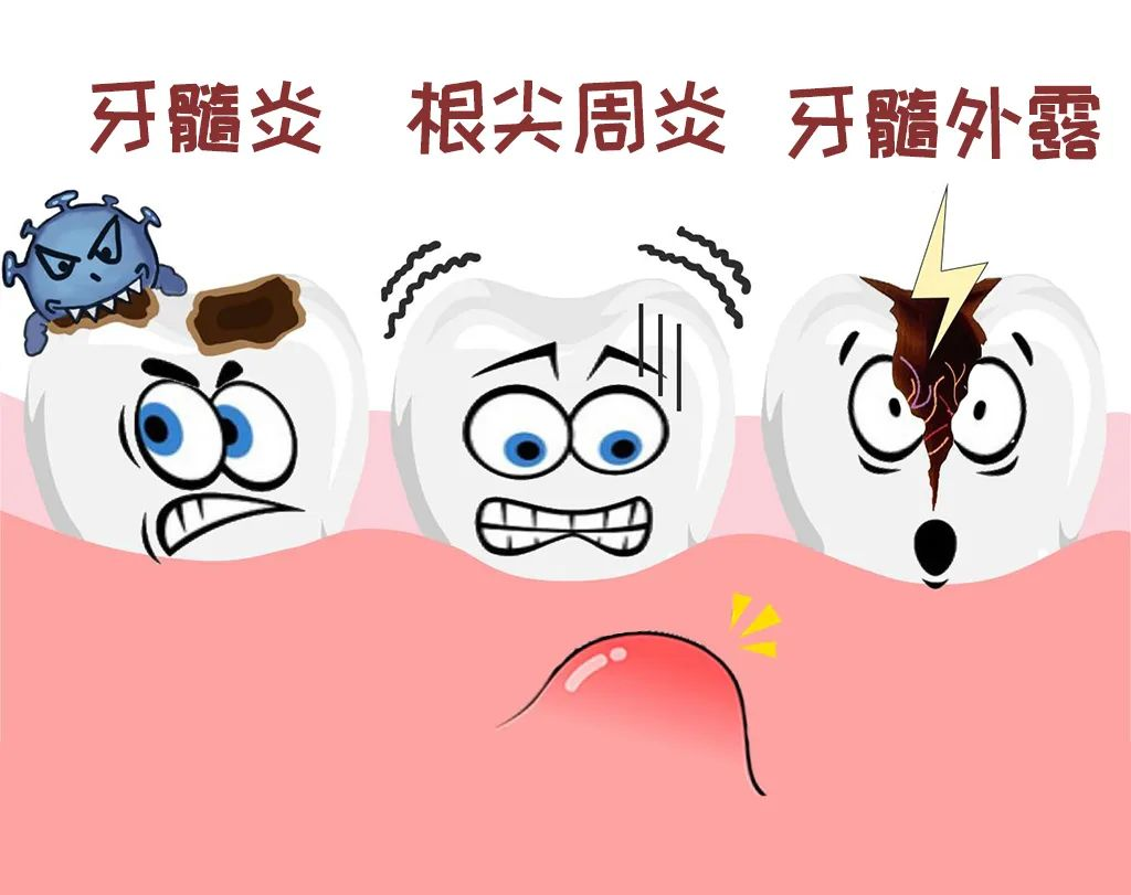 杜牙根情況，牙髓病