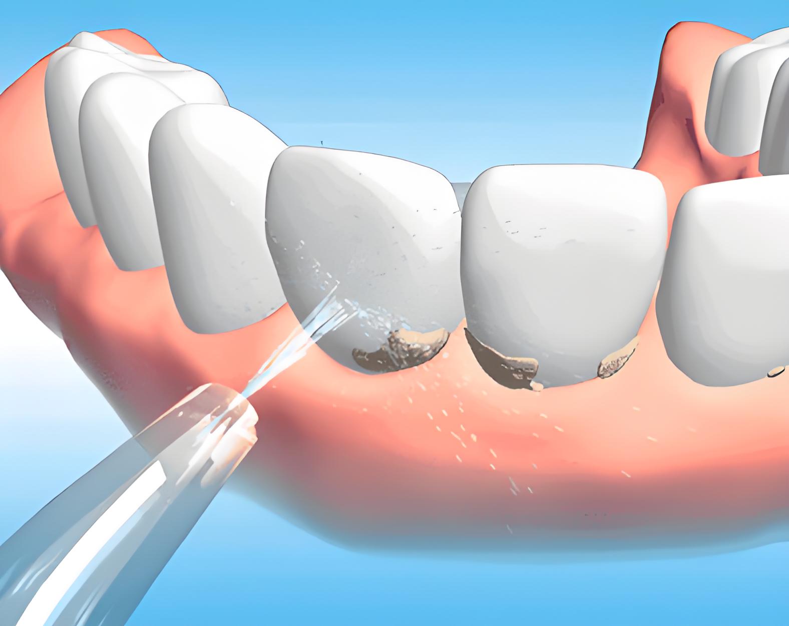 深圳維港口腔喷砂洗牙示意圖
