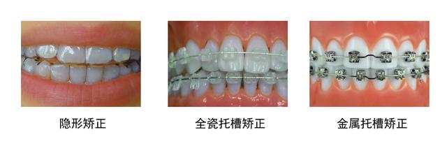 深圳牙齒矯正-深圳箍牙-深圳箍牙價錢-深圳箍牙價目表-維港口腔-維港歡笑口腔