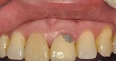 深圳牙冠科普—烤瓷牙崩瓷了一定要換掉整個牙冠嗎？