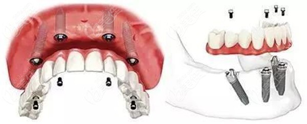種植牙後多長時間可以開始吃東西呢？