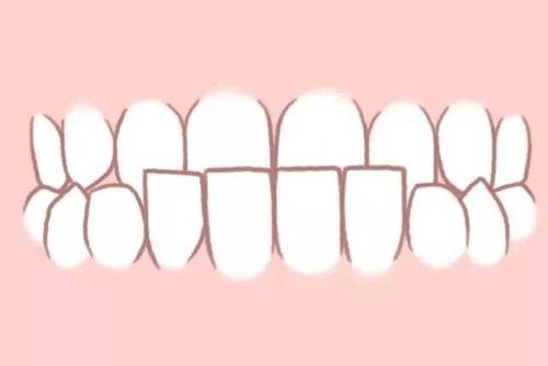 兒童口腔不良習慣有哪些危害？兒童牙齒矯正的要多久？