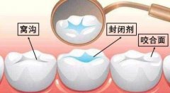 什麼是窩溝封閉？