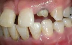 拔除殘根有什麼方法呢？