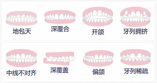 深圳箍牙