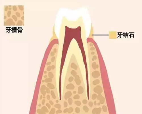 深圳洗牙